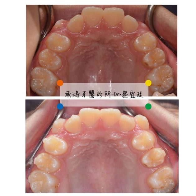 牙齒矯正案例