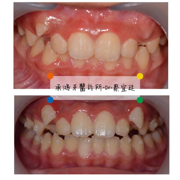 牙齒矯正案例