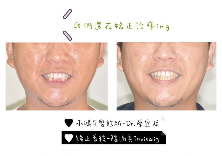 隱適美深咬矯正案例