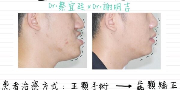 台中正顎手術 x 隱適美 Invisalign 5 (1)