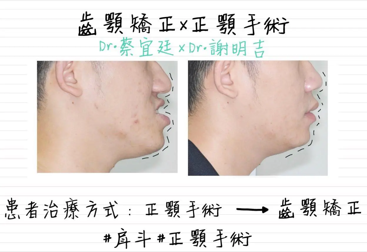 正顎手術x 隱適美invisalign 台中隱適美隱形矯正專家 承鴻牙醫 蔡宜廷醫師 台中牙齒矯正推薦