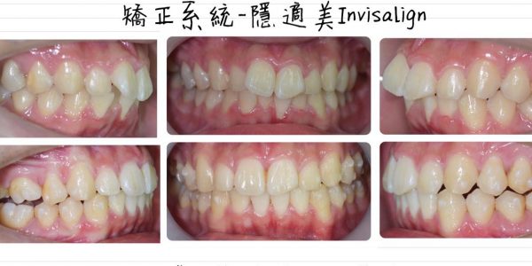 不對稱拔牙、蝴蝶牙 5 (1)