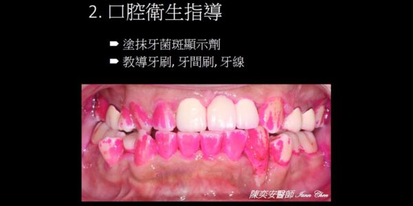 口腔衛生-牙菌斑顯示劑 5 (1)