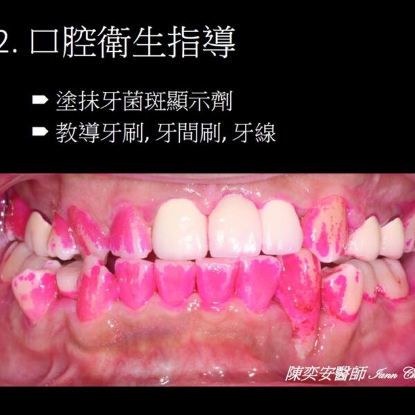 口腔衛生-牙菌斑顯示劑