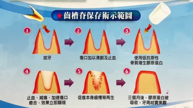 膠原蛋白敷料示意圖 台中拔智齒專家