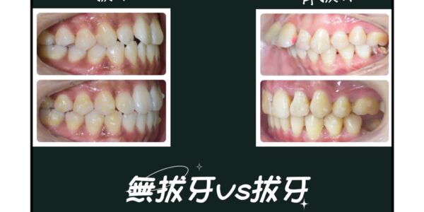 牙齒矯正有沒有拔牙有什麼差別? 5 (1)