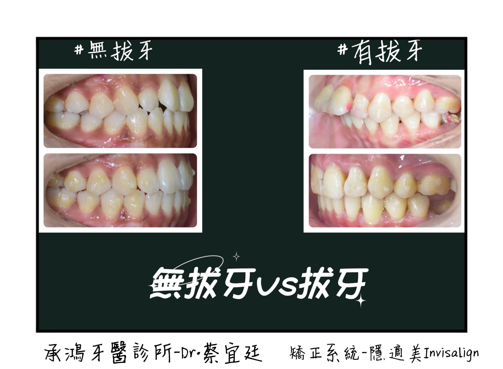 台中牙齒矯正無拔牙有拔牙