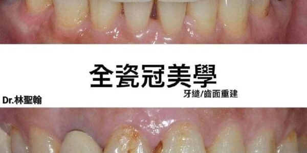 台中假牙醫師 – 林聖翰醫師的全瓷冠美學 5 (1)