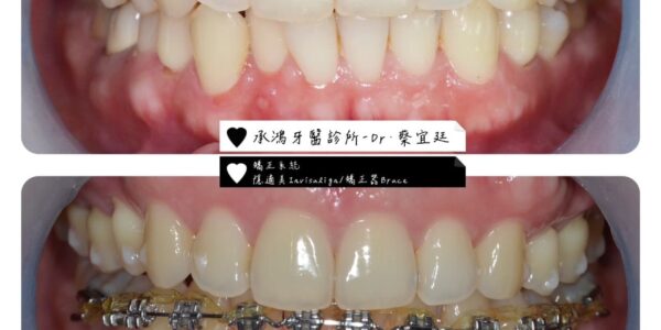 拔牙矯正 – 替代法、雙系統⿒顎矯正 5 (2)