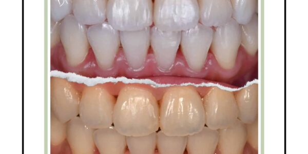 居家牙齒美白 5 (1)