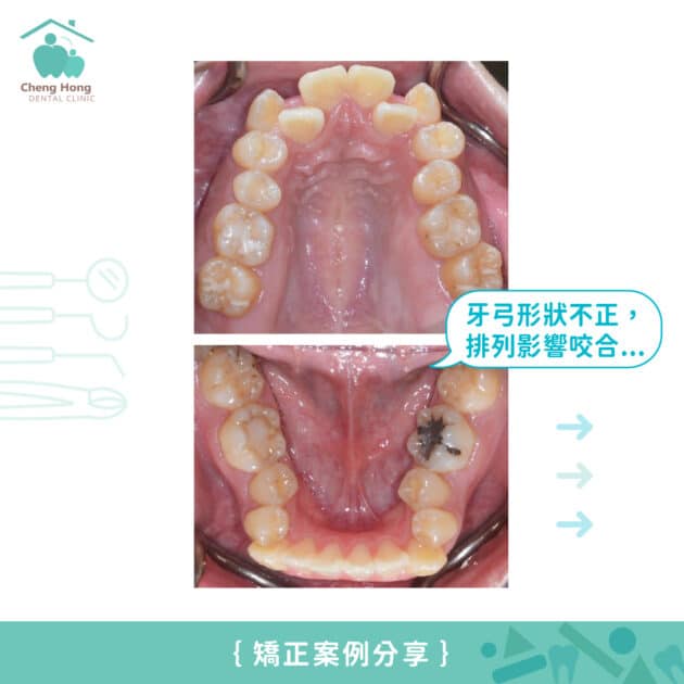 牙齒矯正分享：跟虎牙 Say byebye 篇 | 台中隱適美 - 隱形矯正專家