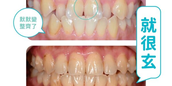 牙齒矯正分享 – 錯位咬合 5 (3)