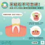 牙結石不清會怎樣？超過 80% 的成人都有牙結石問題