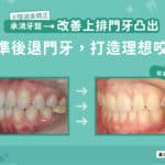 改善上排門牙凸出：精準退後門牙，打造理想咬合