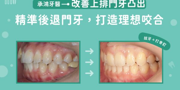 改善上排門牙凸出：精準退後門牙，打造理想咬合 5 (3)