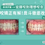 從錯咬到理想咬合