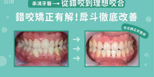 從錯咬到理想咬合 5 (3)