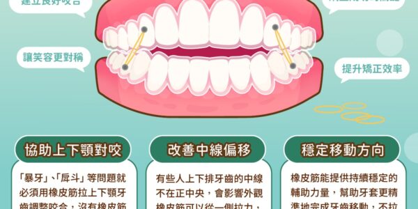矯正小教室，隱形牙套也要拉橡皮筋？ 5 (3)