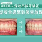 深咬不拔牙矯正：從咬合過緊到笑容放鬆