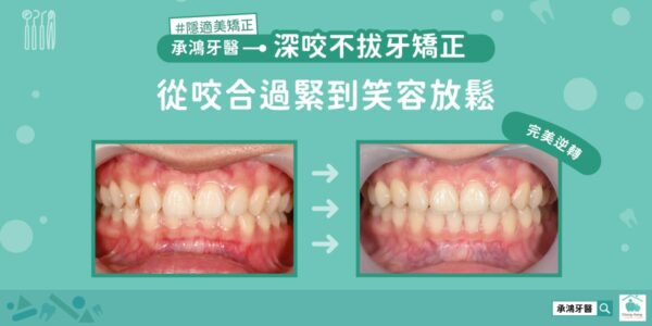 深咬不拔牙矯正：從咬合過緊到笑容放鬆 5 (3)
