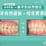 暴牙到自然閉合：前牙自然後退，咬合更漂亮