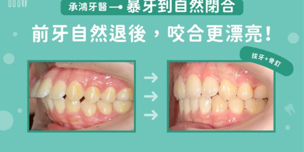 暴牙到自然閉合：前牙自然後退，咬合更漂亮 5 (3)
