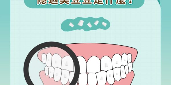矯正小教室，隱適美豆豆是什麼？ 5 (3)