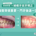 蝴蝶牙拔牙矯正：牙齒整齊很重要，門牙後退一定要