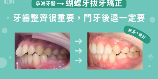 蝴蝶牙拔牙矯正：牙齒整齊很重要，門牙後退一定要 5 (3)