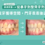 暴牙拔牙矯正：從暴牙到整齊牙列