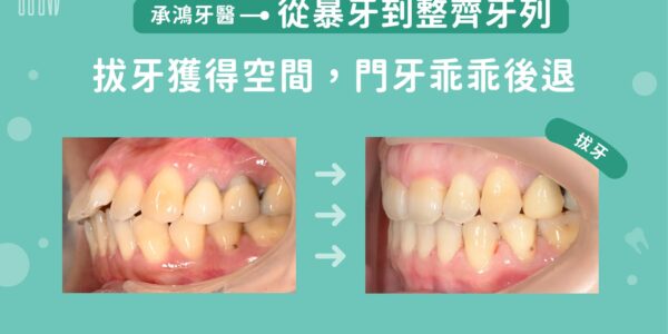 暴牙拔牙矯正：從暴牙到整齊牙列