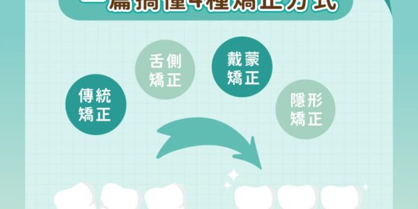 一篇搞懂 4 種牙齒矯正方式 5 (3)