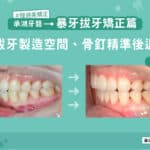暴牙拔牙矯正：拔牙製造空間、骨釘精準後退