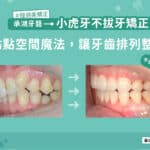 小虎牙不拔牙矯正：一點點空間魔法，讓牙齒排列整齊