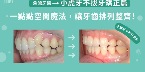 小虎牙不拔牙矯正：一點點空間魔法，讓牙齒排列整齊 5 (3)
