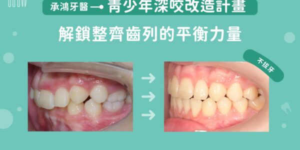 青少年深咬改造計畫：解鎖整齊齒列的平衡力量