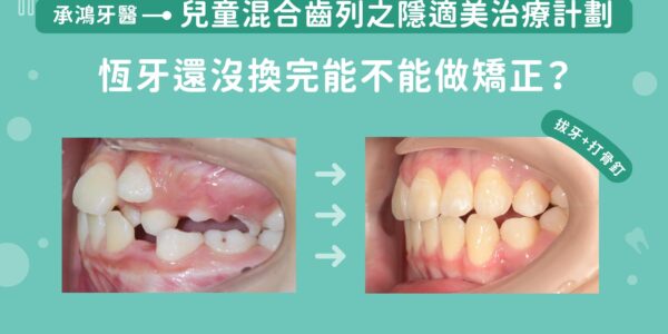 兒童混合齒列之隱適美：恆牙還沒換完能不能做矯正？