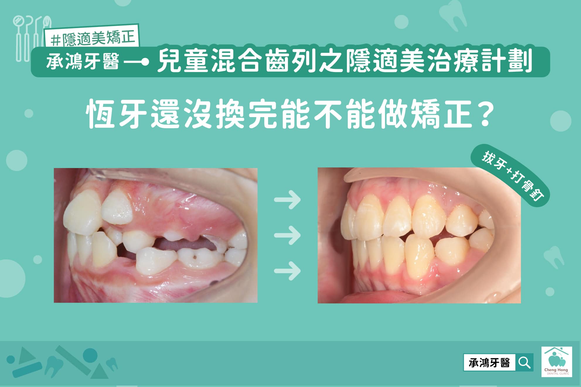 恆牙還沒換完能不能做矯正？
