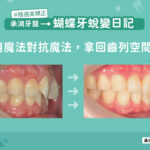 蝴蝶牙蛻變日記：用魔法對抗魔法，拿回齒列空間