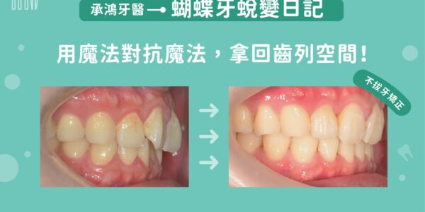 蝴蝶牙蛻變日記：用魔法對抗魔法，拿回齒列空間