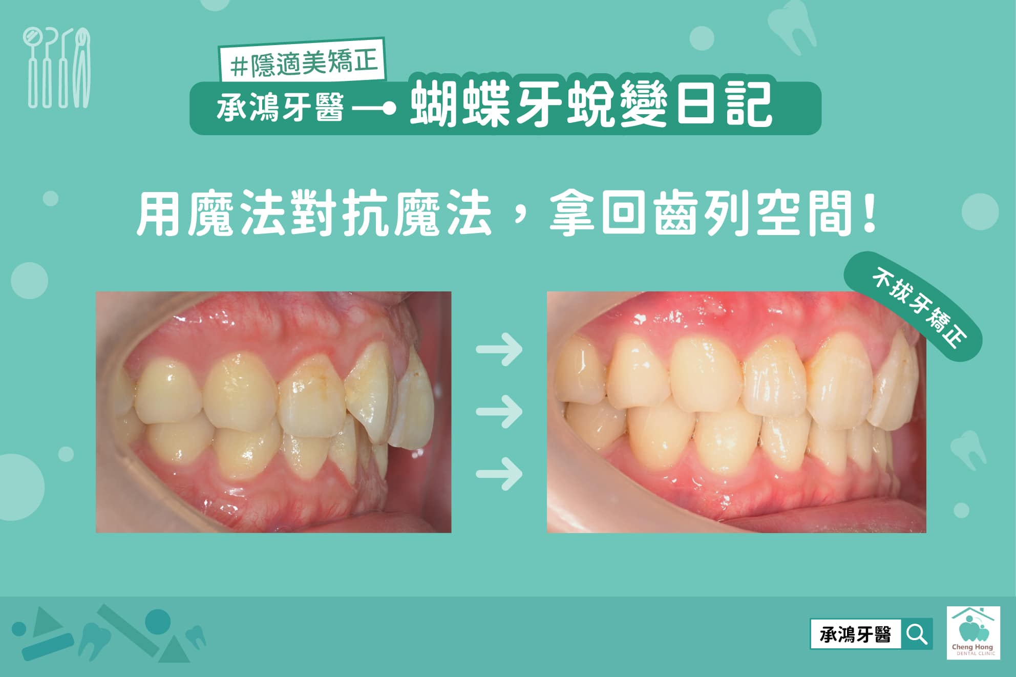 蝴蝶牙蛻變日記