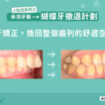 蝴蝶牙撤退計畫：拔牙矯正，換回整個齒列的舒適空間