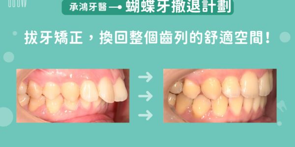蝴蝶牙撤退計畫：拔牙矯正，換回整個齒列的舒適空間