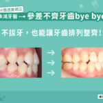 參差不齊牙齒 bye bye 不拔牙，也能讓牙齒排列整齊！