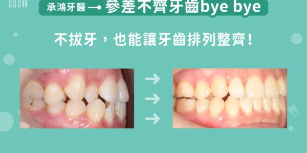 參差不齊牙齒 bye bye 不拔牙，也能讓牙齒排列整齊！