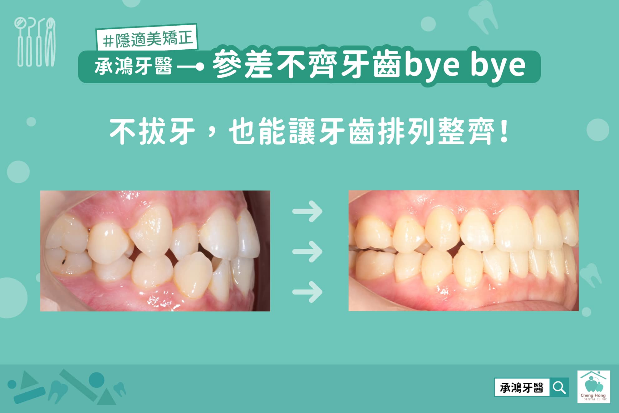 參差不齊牙齒 bye bye，不拔牙，也能讓牙齒排列整齊！