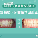 暴牙錯咬OUT!骨釘輔助，牙齒悄悄回到正軌