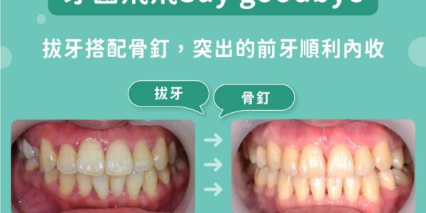 牙齒飛飛 Say goodbye