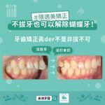 不拔牙也可以解除蝴蝶牙：牙齒矯正真的不是非拔不可