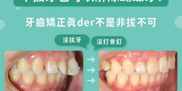 不拔牙也可以解除蝴蝶牙：牙齒矯正真的不是非拔不可